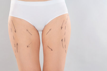 Woman with marks on body for cosmetic surgery operation against grey background, closeupの写真素材