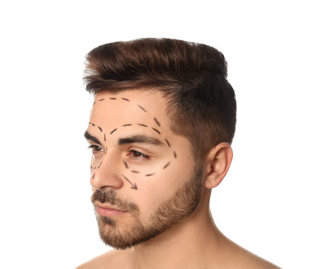 Young man with marks on face for cosmetic surgery operation against white backgroundの写真素材