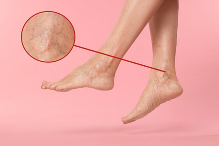 Woman suffering from varicose veins on pink background, closeup. Magnified skin surface showing...