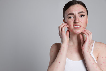 Woman with rash suffering from monkeypox virus on light gray background. Space for textの写真素材