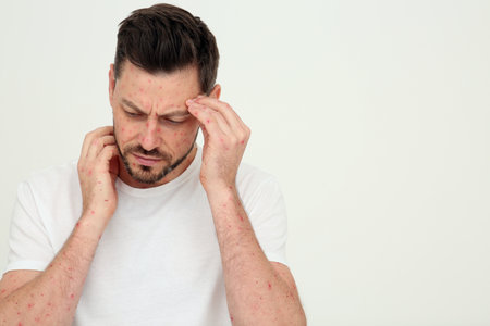 Man with rash suffering from monkeypox virus on beige background. Space for text
