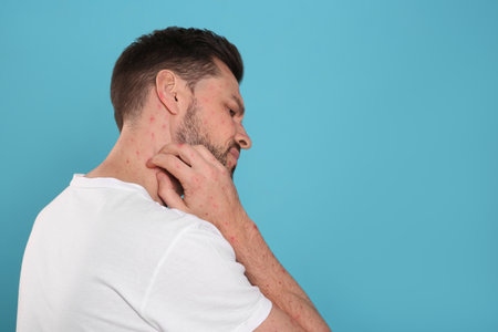 Man with rash suffering from monkeypox virus on light blue background. Space for text