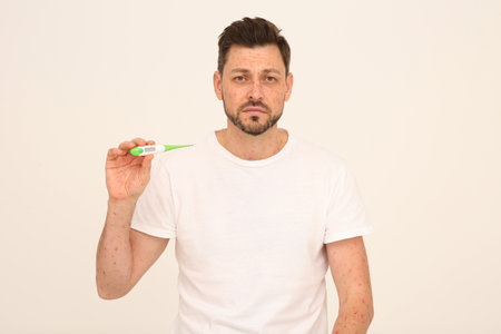 Man with rash holding thermometer on beige background. Monkeypox virus diagnosis