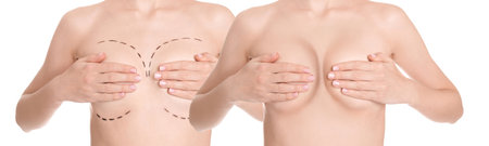Breast augmentation surgery. Photos of woman before with marks on skin and after with silicone implants, closeup. Collage design on white backgroundの写真素材