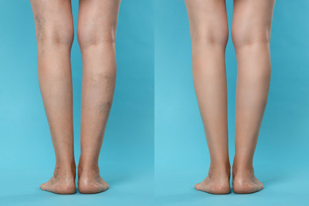 Before and after varicose veins treatment. Collage with photos of woman showing legs on light blue background, closeupの写真素材