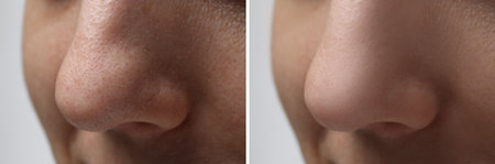 Before and after acne treatment. Photos of woman on white background, closeup. Collage showing affected and healthy skinの写真素材