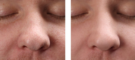 Photos of man before and after acne treatment, closeup. Collage showing affected and healthy skinの写真素材