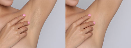 Before and after epilation. Collage with photos of woman showing armpit on light background, closeupの写真素材
