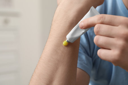 Man applying yellow ointment from tube onto his arm indoors, closeupの写真素材