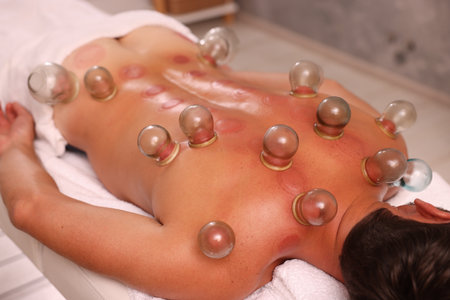 Cupping therapy. Closeup view of man with glass cups on his back in spa salon