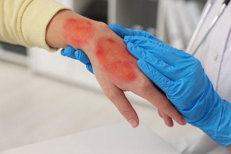 Doctor examining patient's burned hand indoors, closeupの写真素材