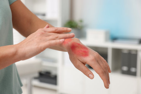 Woman applying healing cream onto burned hand indoors, closeup