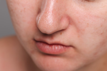 Closeup view of woman with comedones on her noseの写真素材
