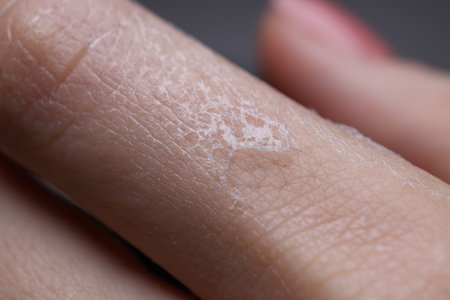 Woman with dry skin on hand, macro viewの写真素材