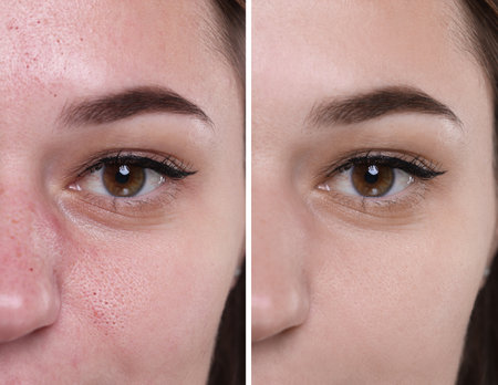 Blackhead treatment, before and after. Collage with photos of woman, closeup viewの写真素材