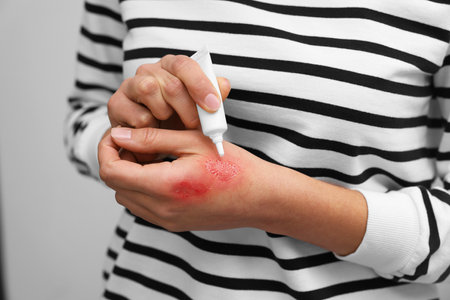 Woman applying healing cream onto burned hand on light gray background, closeup