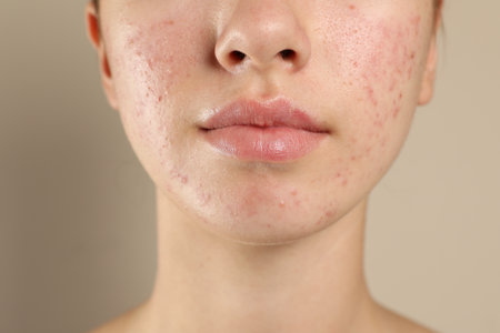 Teenage girl with acne problem on beige background, closeupの写真素材