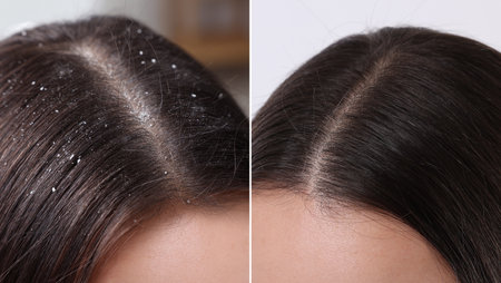 Woman showing hair before and after dandruff treatment, collageの写真素材