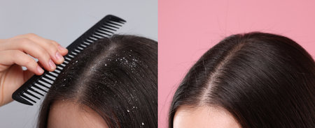 Woman showing hair before and after dandruff treatment on color backgrounds, collageの写真素材