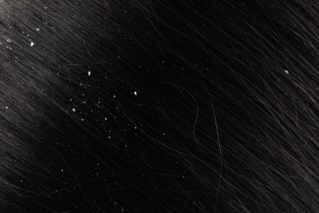 Closeup view of dark woman`s hair with dandruffの写真素材