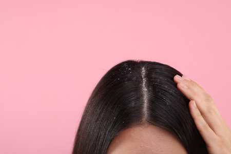 Woman with dandruff in her dark hair on pink background, closeup. Space for textの写真素材
