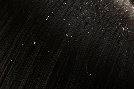 Woman with dandruff in her dark hair, closeup viewの写真素材