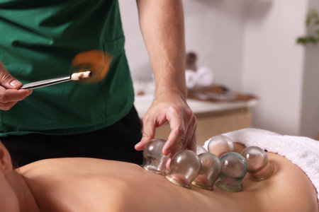 Therapist giving fire cupping treatment to patient indoors, closeupの写真素材