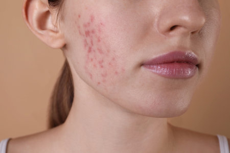 Young woman with acne problem on beige background, closeupの写真素材