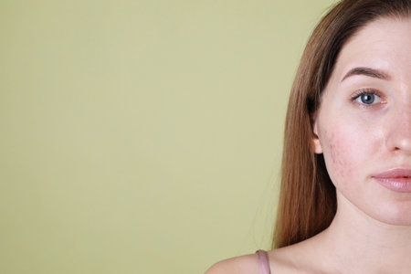 Young woman with acne problem on olive background, closeup. Space for text
