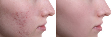 Acne problem. Young woman before and after treatment on white background, closeup. Collage of photosの写真素材