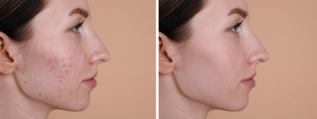 Acne problem. Young woman before and after treatment on beige background, collage of photosの写真素材