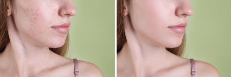 Acne problem. Young woman before and after treatment on green background, closeup. Collage of photosの写真素材