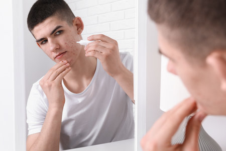 Young man with acne problem applying cosmetic product onto his skin near mirror indoorsの写真素材