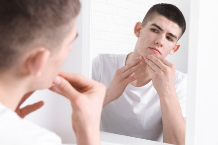 Young man looking at mirror and touching pimple on his face indoors. Acne problemの写真素材