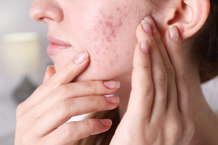 Woman with acne problem at home, closeupの写真素材