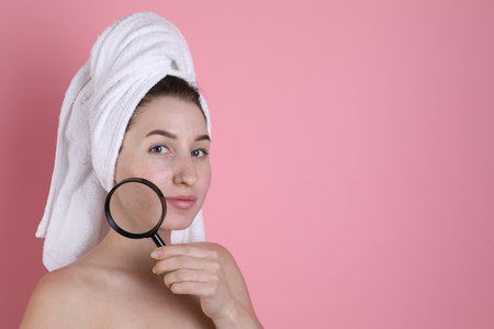 Young woman with acne problem holding magnifying glass near her skin on pink background. Space for...