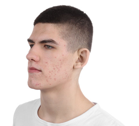 Young man with acne problem isolated on whiteの写真素材