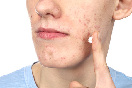 Young man with acne problem applying cosmetic product onto his skin on white background, closeupの写真素材