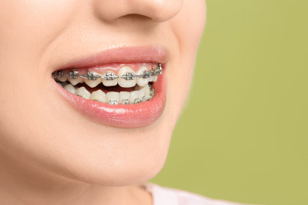 Smiling woman with dental braces on light green background, closeup. Space for text