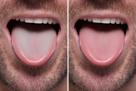 Man showing his tongue before and after cleaning procedure, closeup. Tongue coated with plaque on one side and healthy on other, collageの写真素材