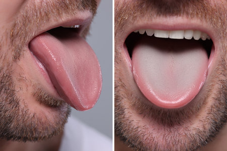 Man showing his tongue before and after cleaning procedure, closeup. Tongue coated with plaque on one side and healthy on the other, collageの写真素材