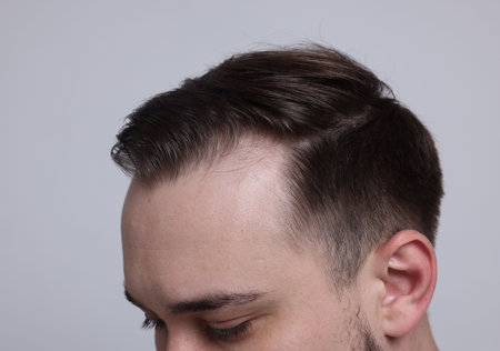 Baldness concept. Man with receding hairline on light grey background, closeup