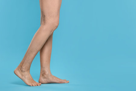 Closeup view of woman with varicose veins on light blue background. Space for text