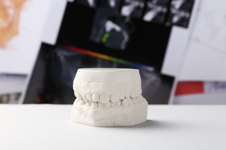 Dental model with gums on white table against panoramic x-ray. Cast of teethの写真素材