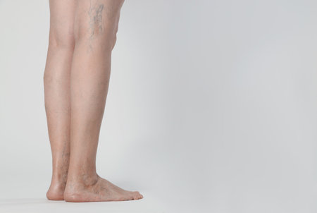 Closeup view of woman with varicose veins on light background. Space for textの写真素材