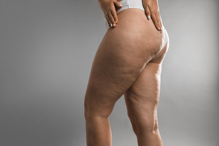 Woman with cellulite on gray background, closeup. Space for textの写真素材