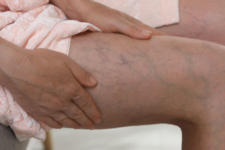 Woman suffering from varicose veins indoors, closeup