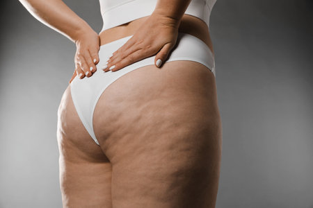 Woman with cellulite on gray background, closeup. Space for textの写真素材