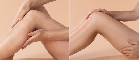 Varicose veins treatment. Woman showing legs on dark beige background, closeup. Before and after collageの写真素材