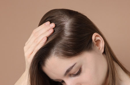 Girl with hair loss problem on dark beige backgroundの写真素材